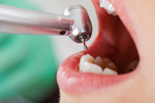 Best Dentist for Tooth Abscess  in Forest City, FL